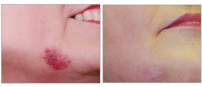 Birthmark on the chin treated with a laser at the Vein Center and CosMed.