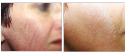 Learn about our rosacea and acne treatments at the Vein Center and CosMed.