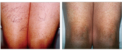 Spider veins on upper thighs treated by sclerotherapy at the Vein Center and CosMed