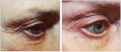 Skin tightening around the eyes and brow done by the Vein Center and CosMed. 