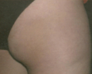 Cellulite and fat of thigh and hip treated by the Vein Center and CosMed.