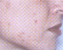 Acne treated with a laser by the Vein Center and CosMed. 