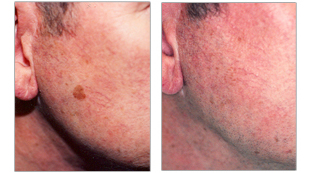 Pigmented lesion on the right cheek treated by laser light therapy at the Vein Center and CosMed.