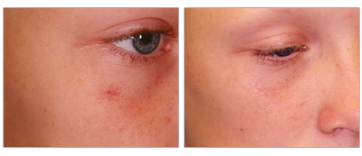 Learn about our red spots and hemangiomas treatment options at the Vein Center and CosMed.